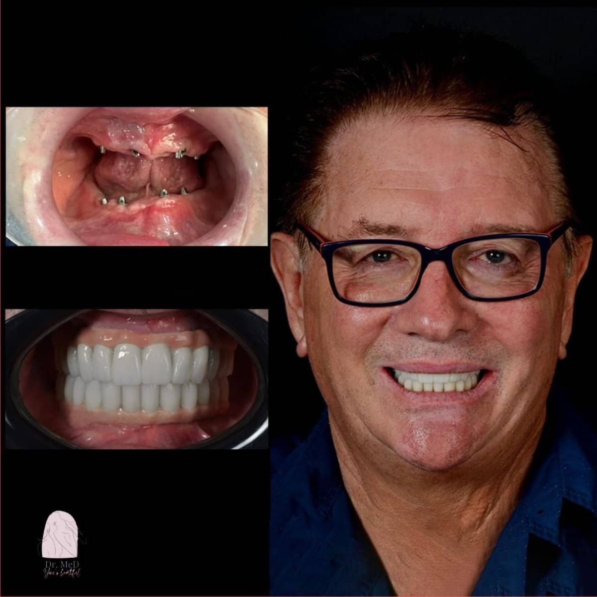 Case 18586 - dental implant