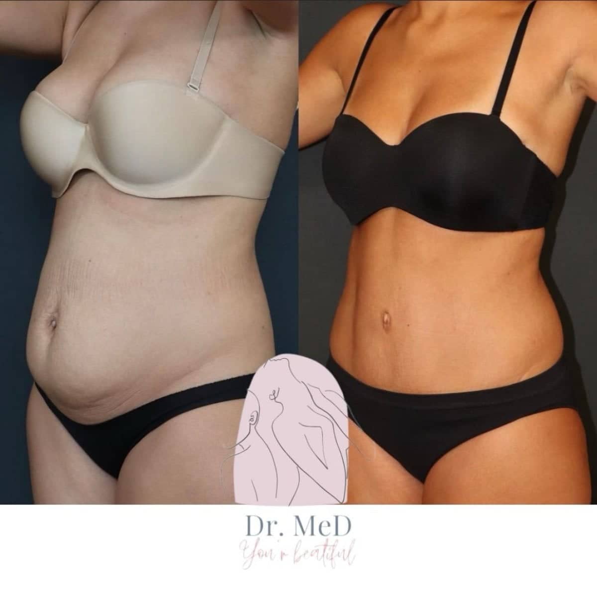 Case 18588 - liposuction