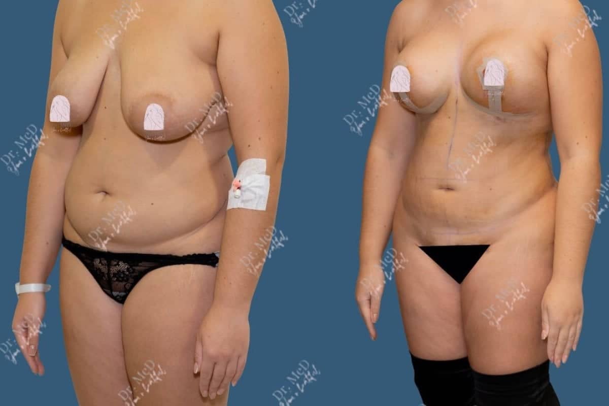 Case 18589 - liposuction
