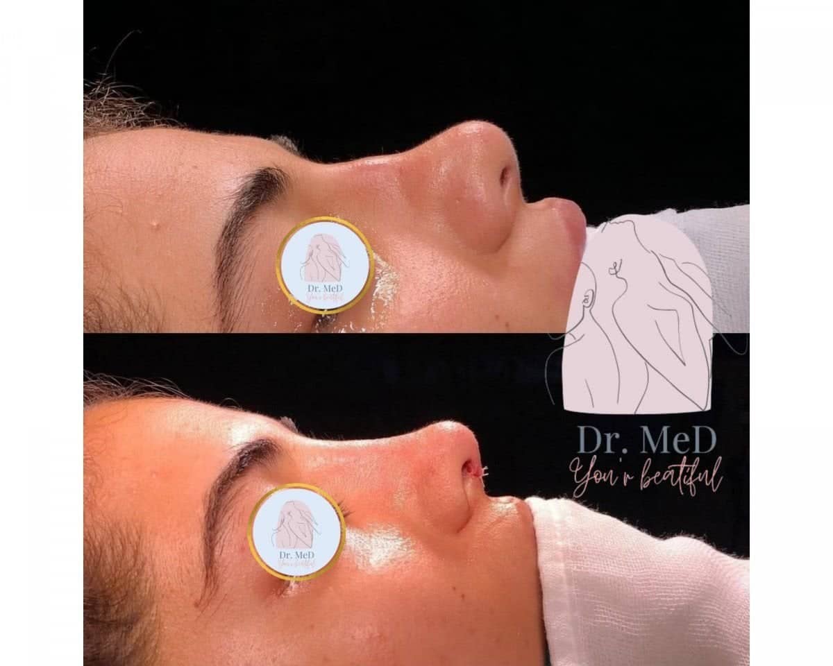 Case 18591 - septoplasty