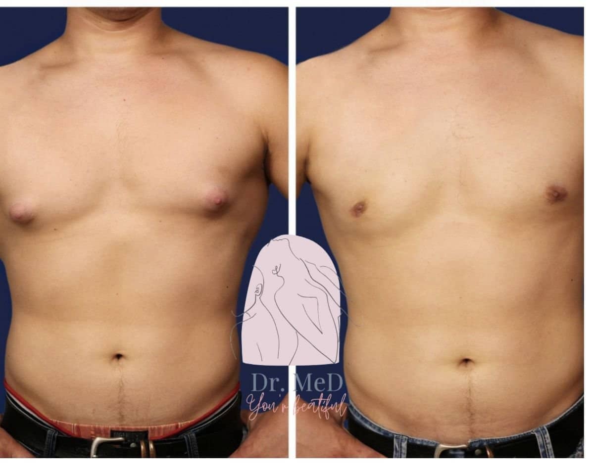 Case 18592 - liposuction