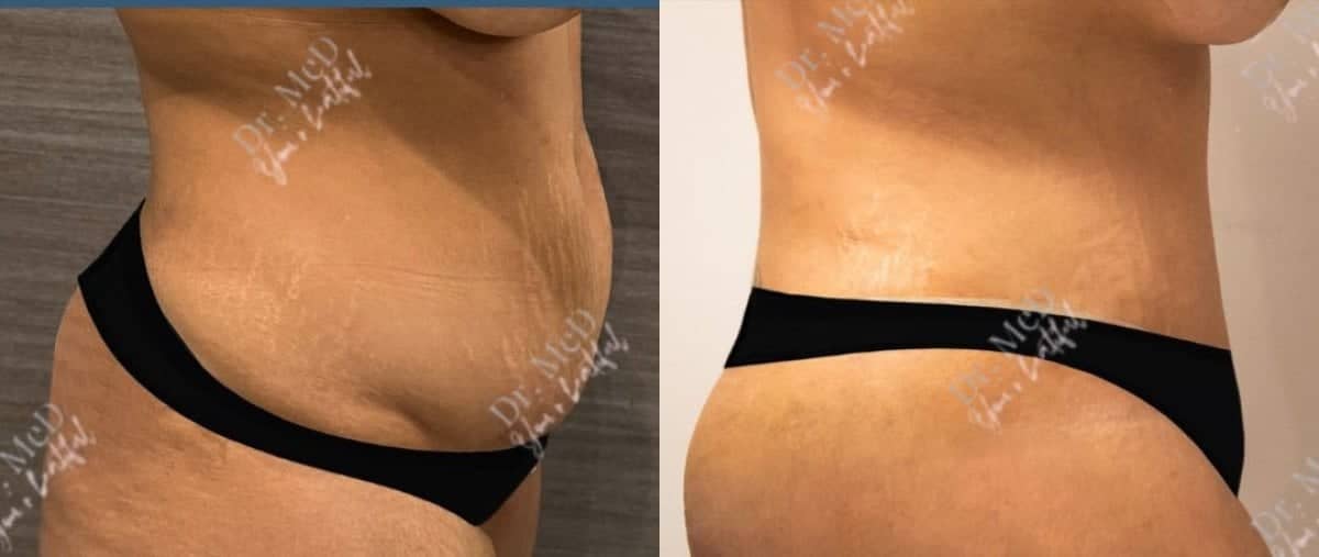 Case 18595 - liposuction