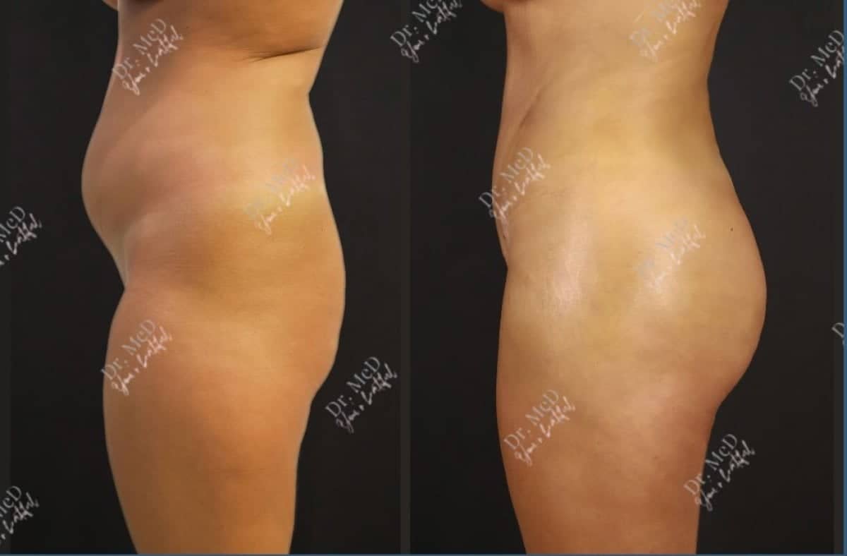 Case 18597 - liposuction