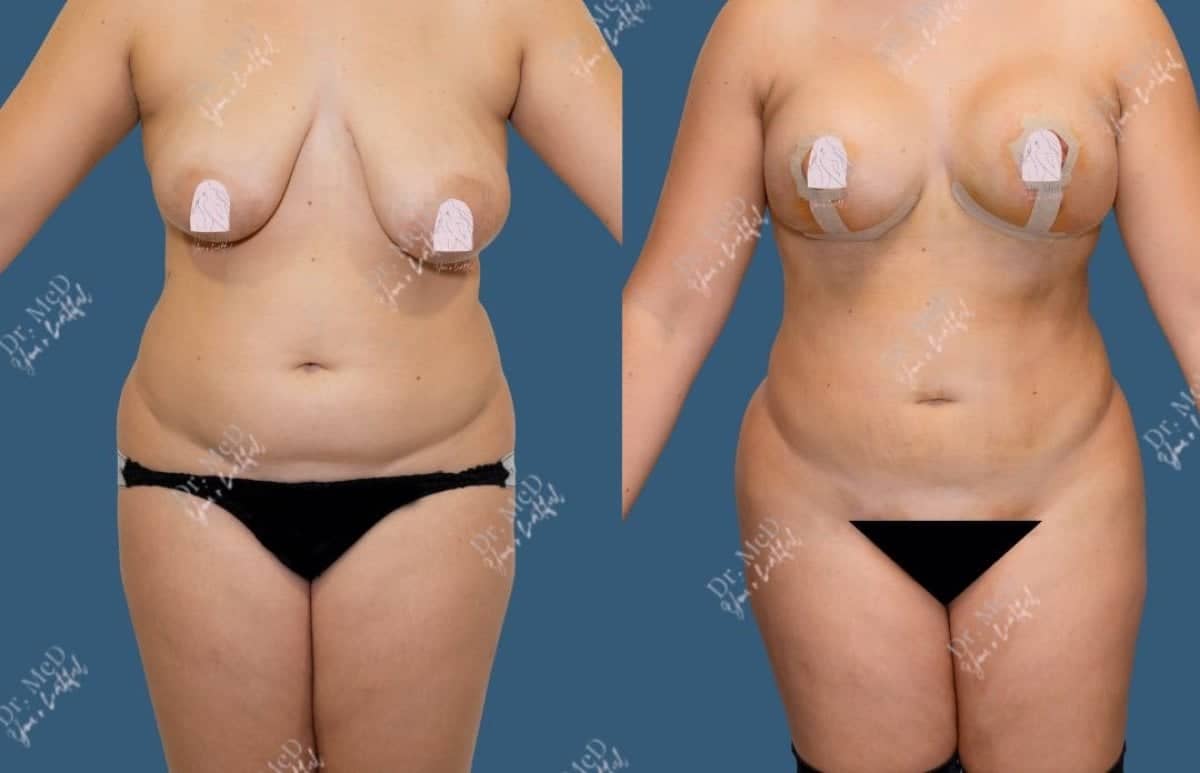 Case 18600 - liposuction