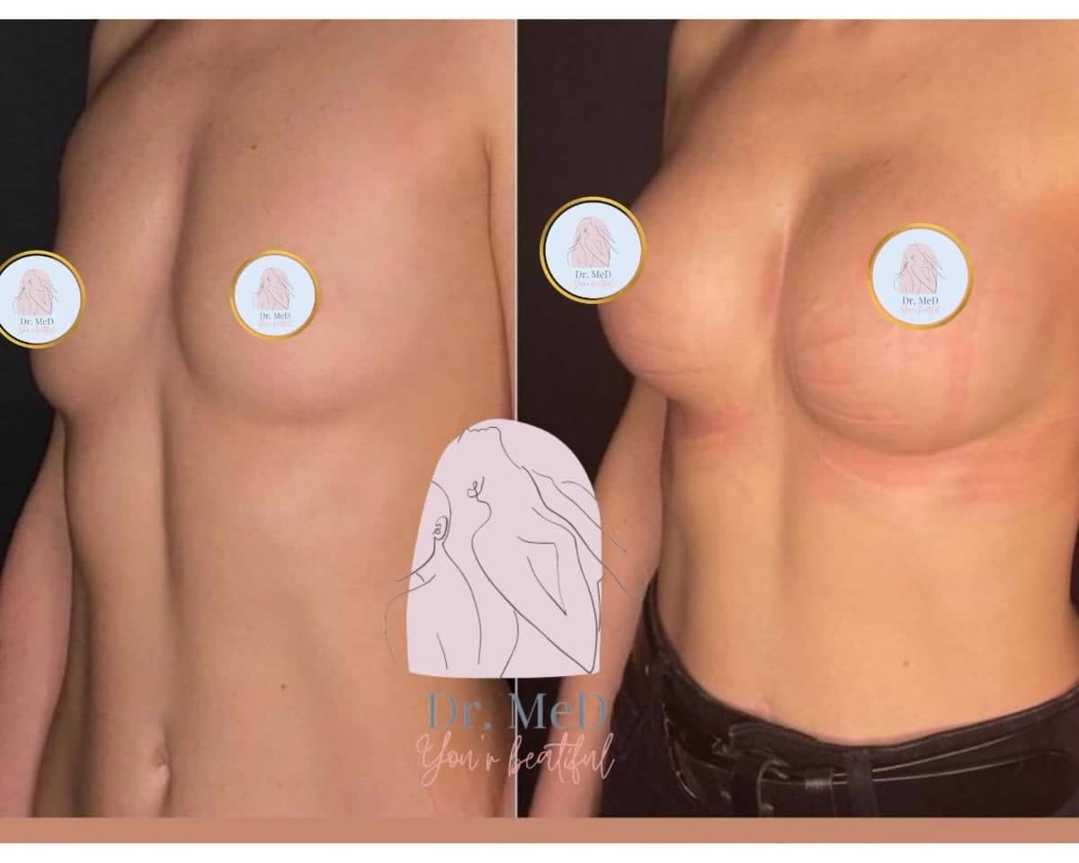 Case 18602 - breast augmentation
