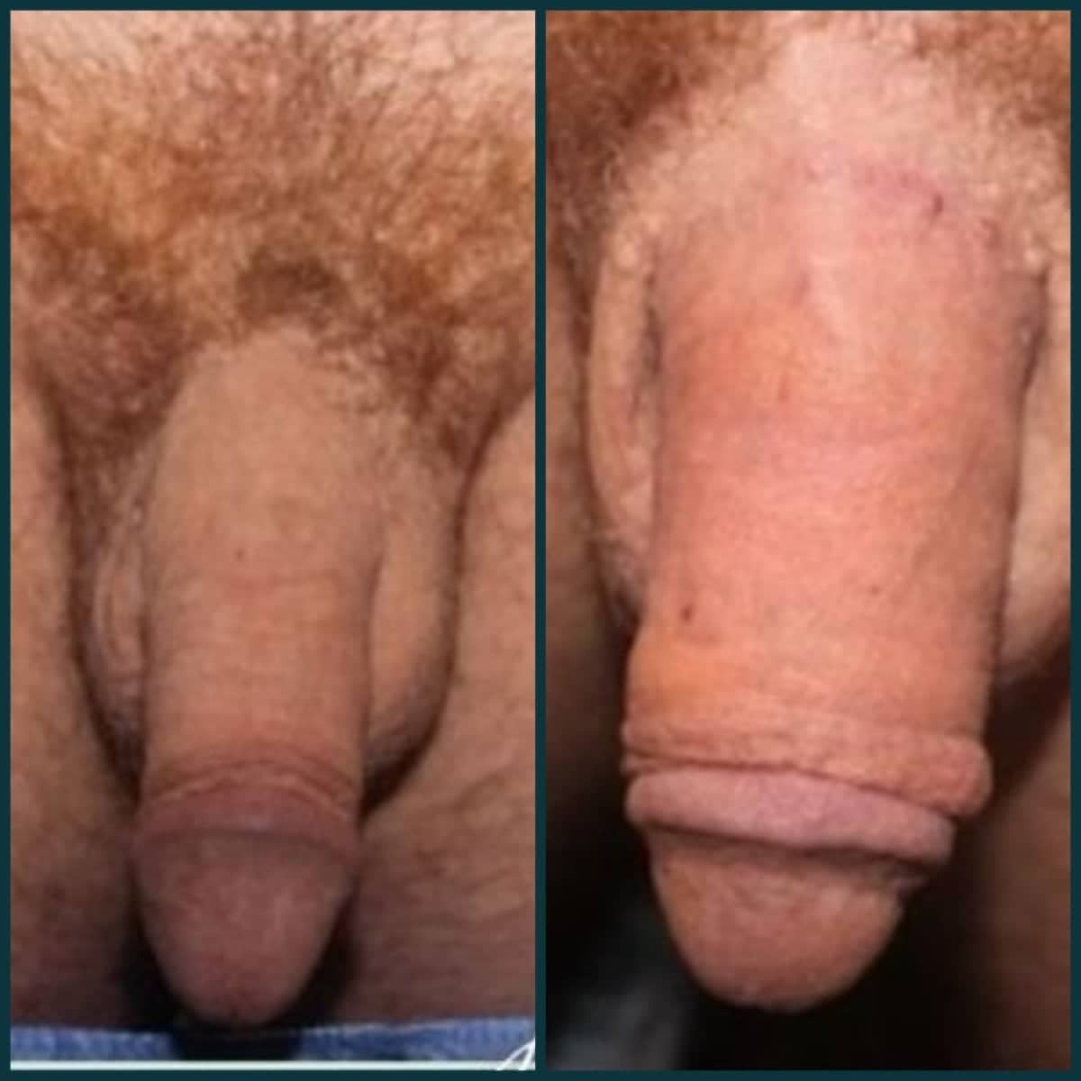 Case 18618 - penile implant surgery