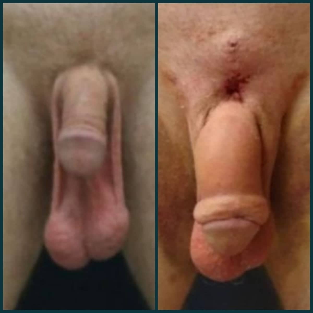Case 18623 - penile implant surgery