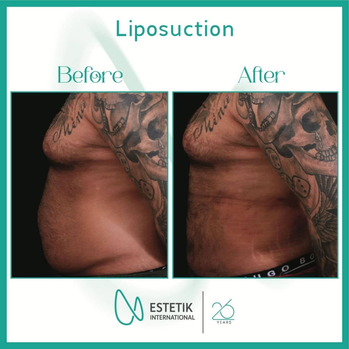 Case 18640 - liposuction