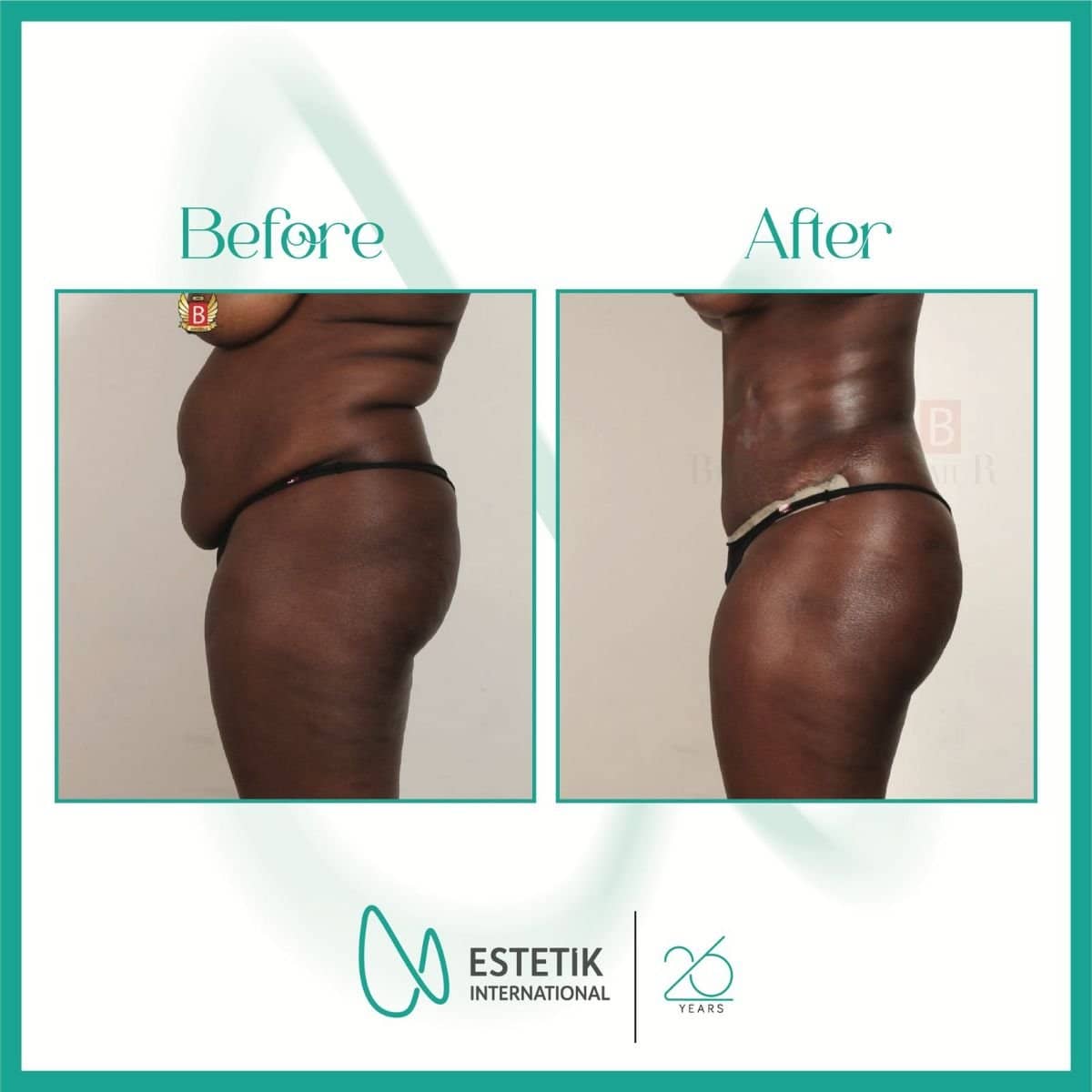 Case 18647 - tummy tuck and liposuction