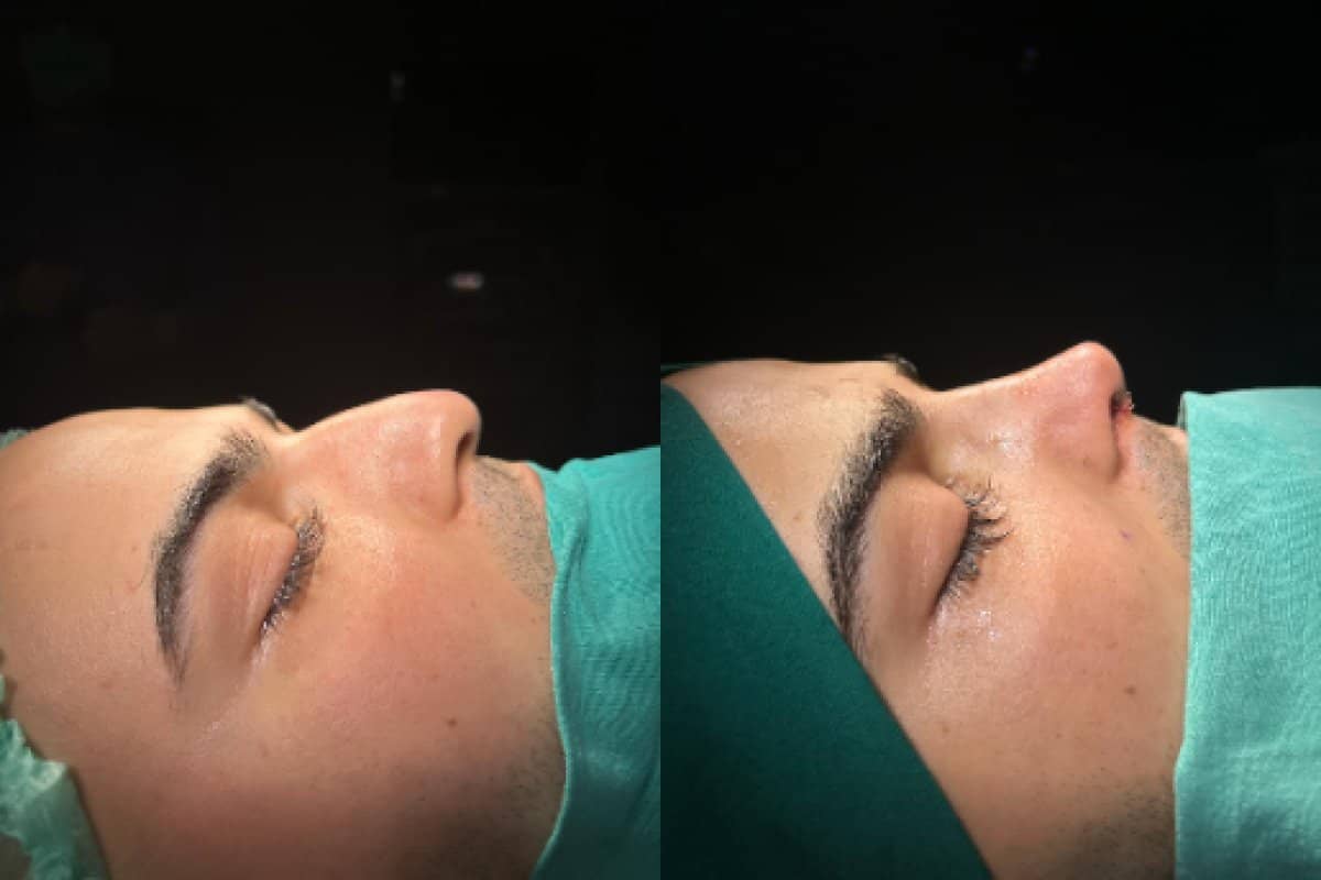 Case 18655 - rhinoplasty