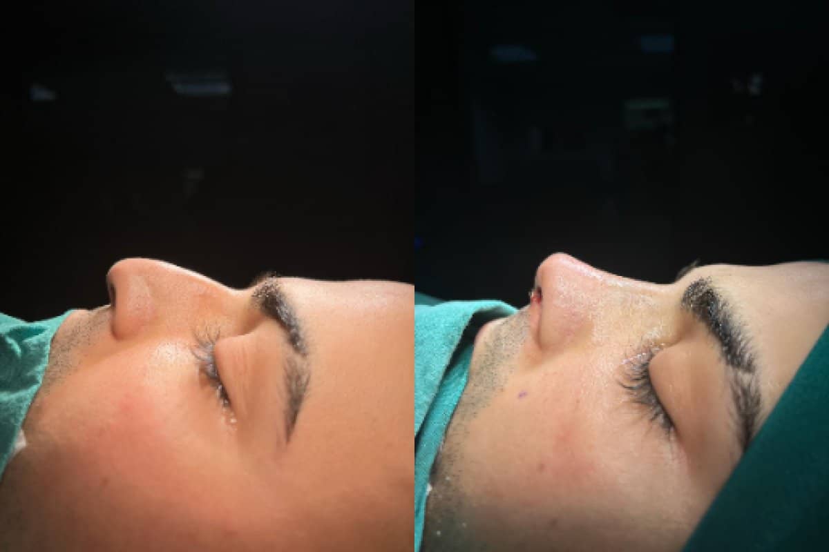 Case 18656 - rhinoplasty