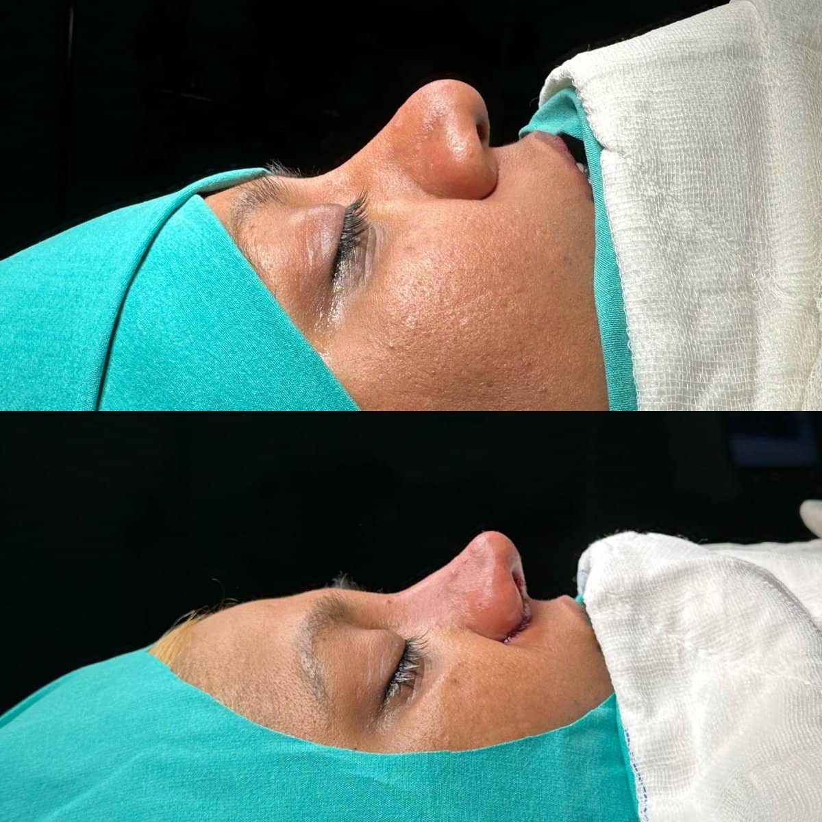 Case 18658 - rhinoplasty