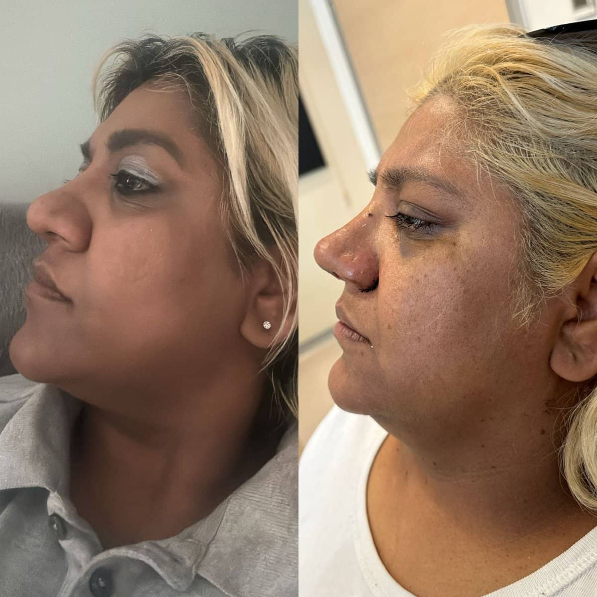 Case 18661 - rhinoplasty
