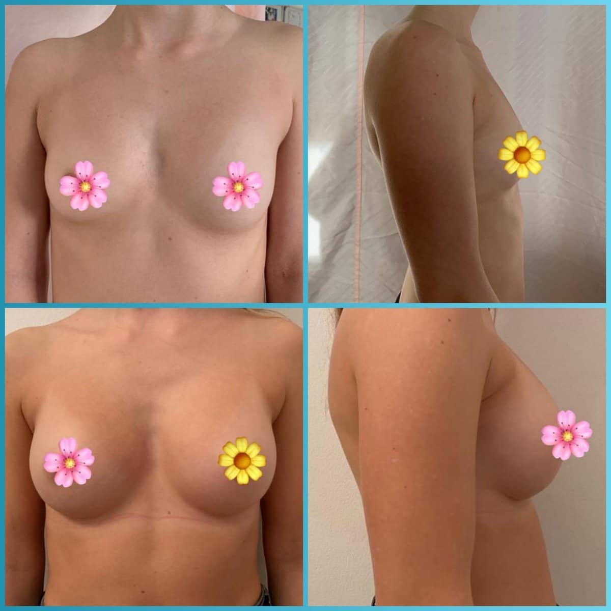 Case 18667 - breast implants with lift