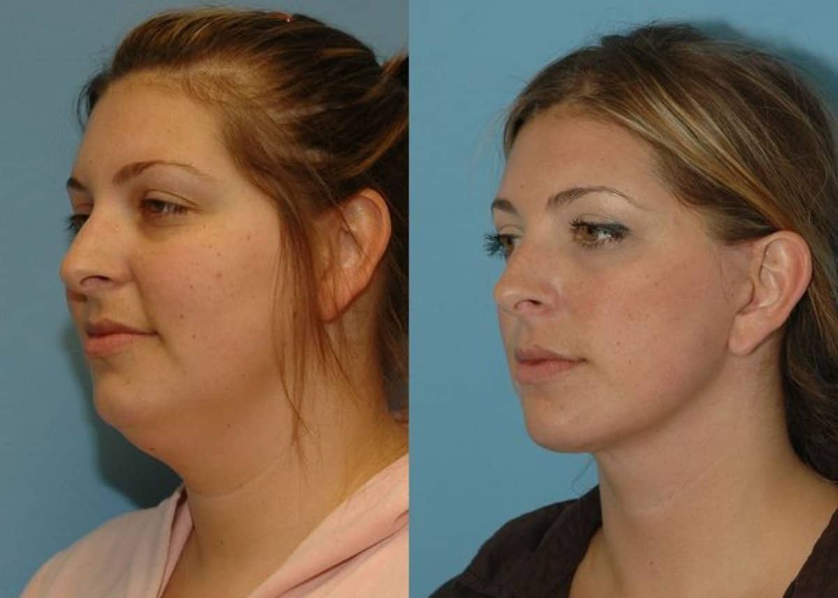 Case 18669 - liposuction