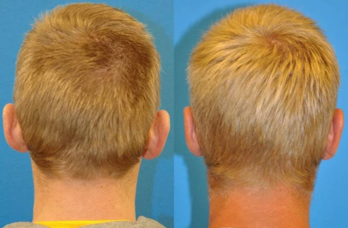 Case 18670 - otoplasty