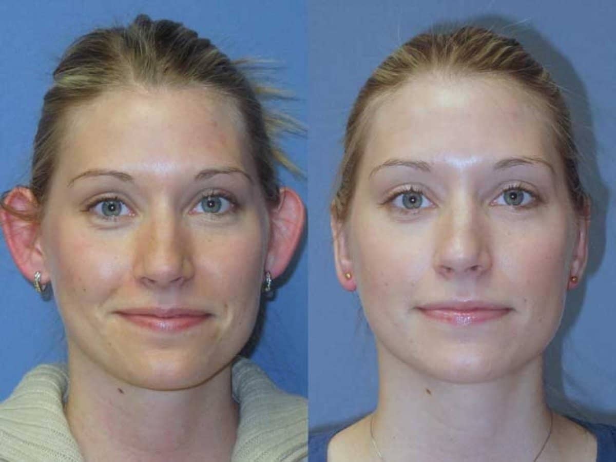 Case 18671 - otoplasty