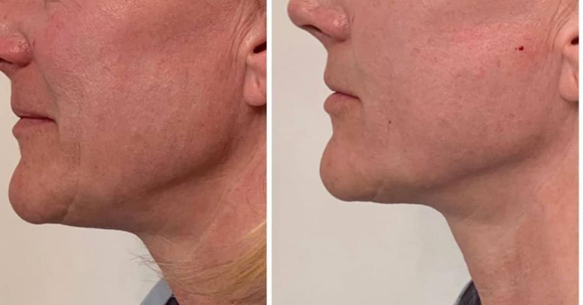 Case 18672 - neck liposuction