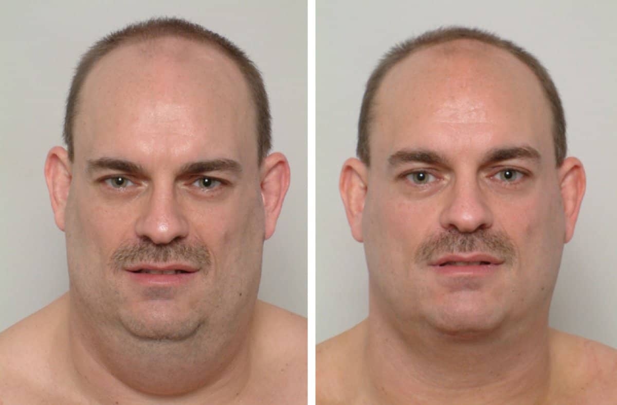 Case 18673 - neck liposuction