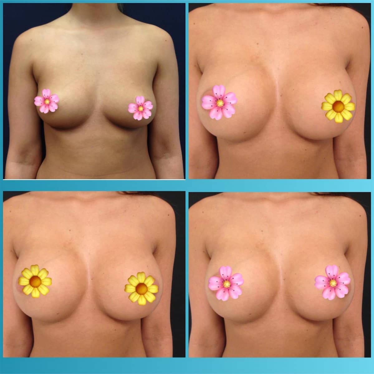 Case 18674 - breast implants with lift