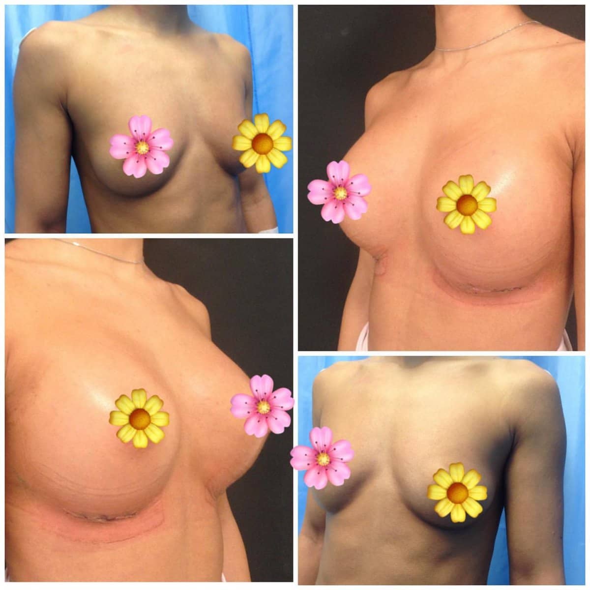 Case 18675 - breast implants with lift