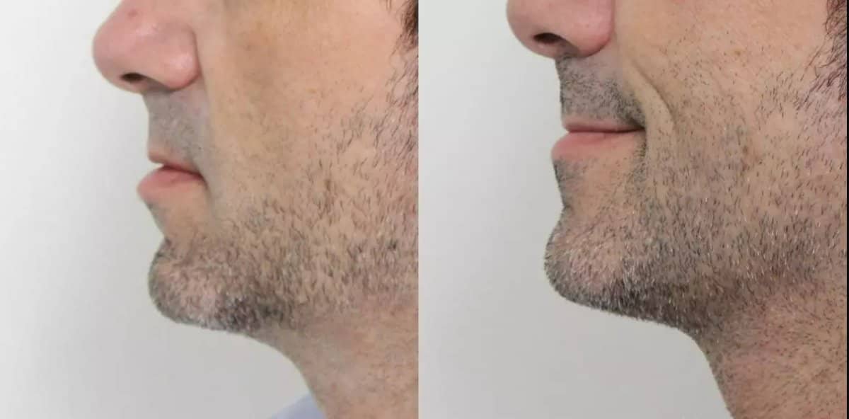 Case 18678 - neck liposuction