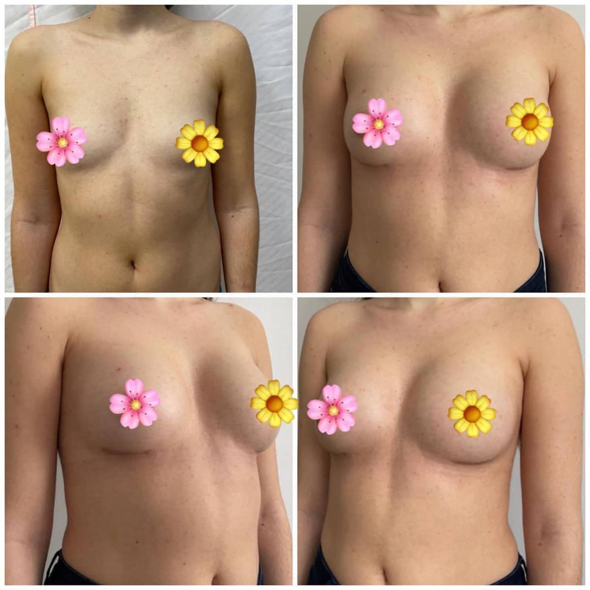 Case 18679 - breast implants with lift