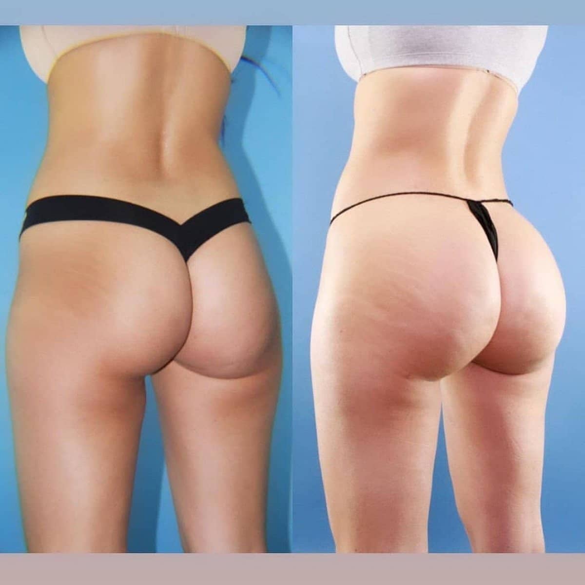 Case 18680 - Brazilian Butt Lift