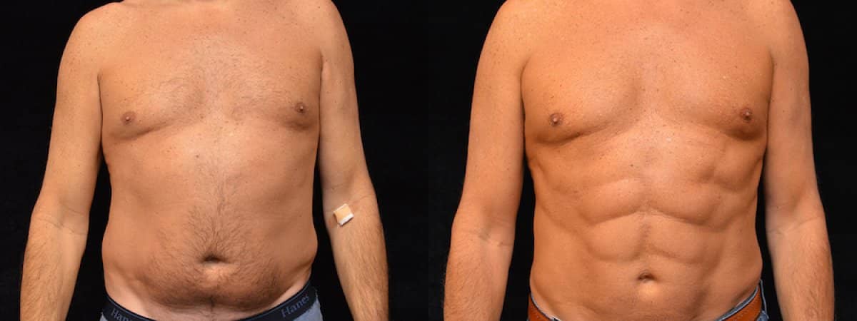 Case 18681 - male liposuction