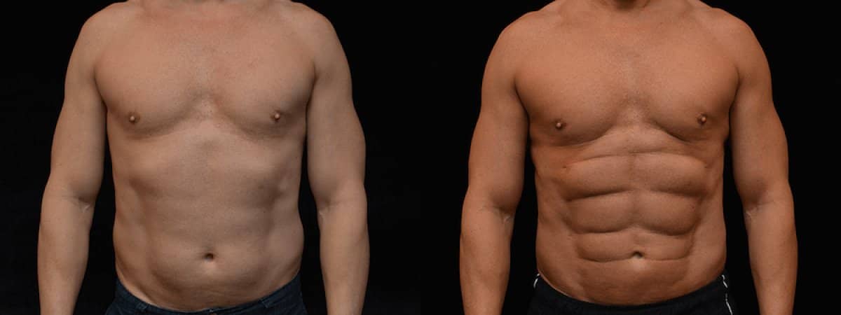Case 18682 - liposuction