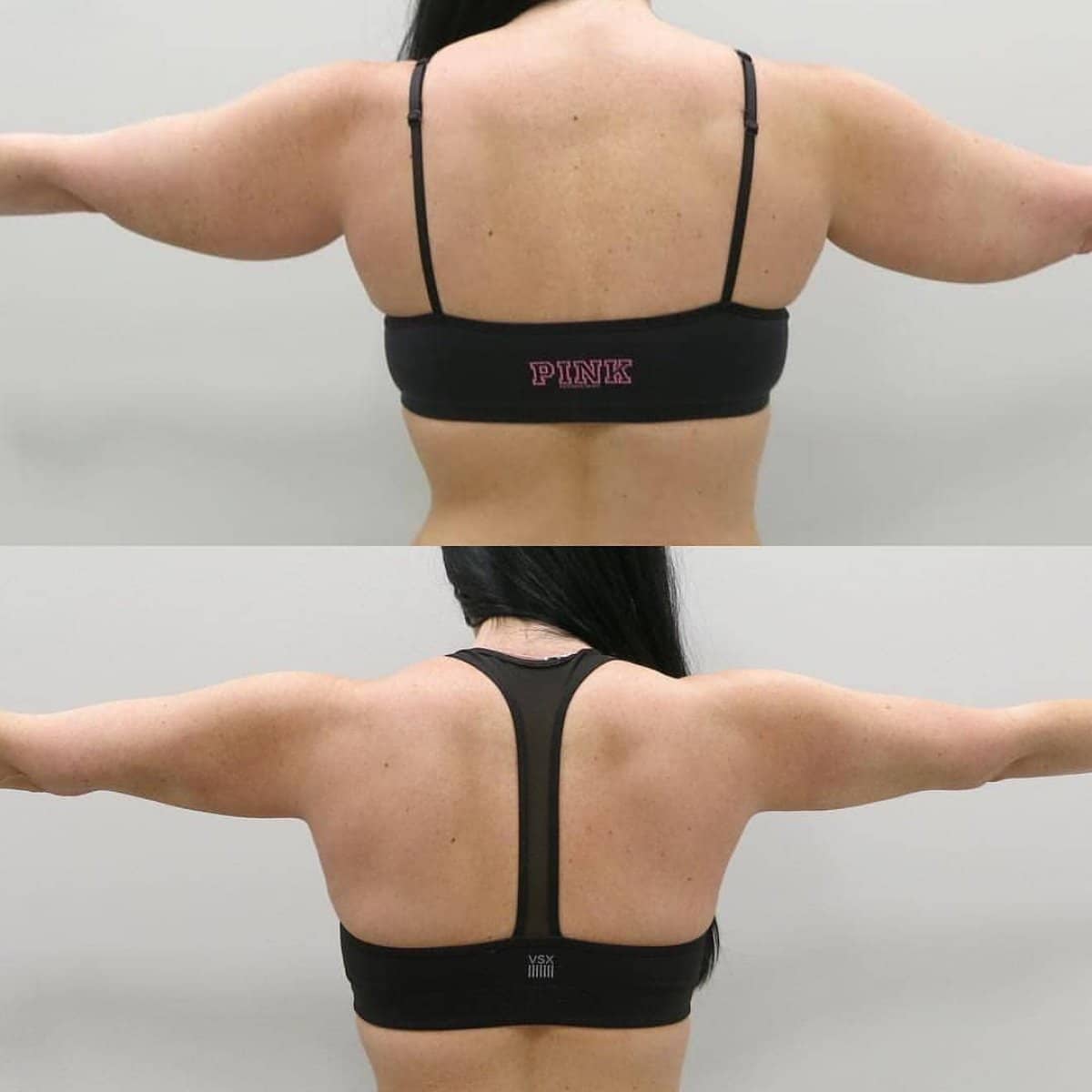 Case 18684 - upper arm liposuction