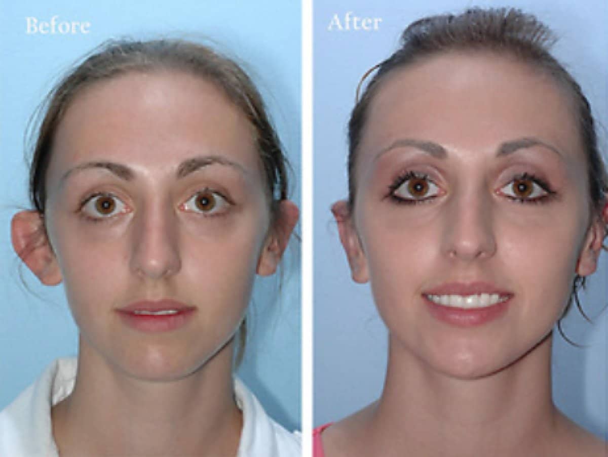Case 18685 - otoplasty