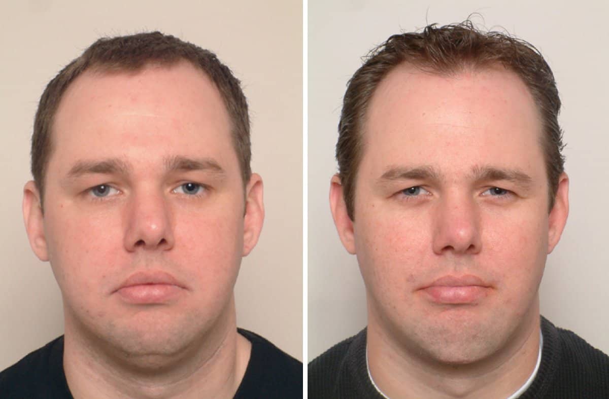 Case 18693 - neck liposuction
