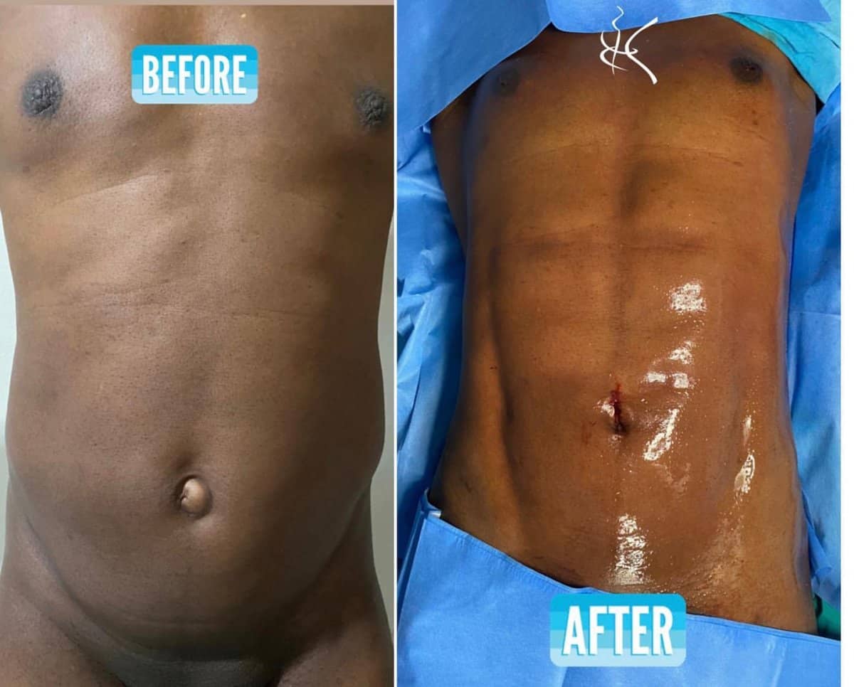 Case 18696 - Vaser liposuction