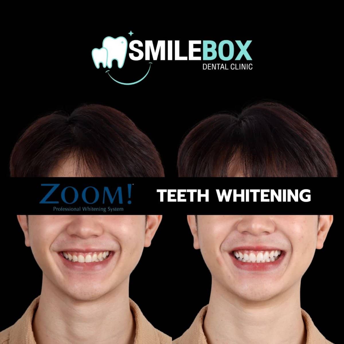 Case 18739 - teeth whitening