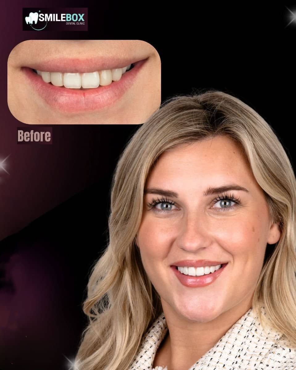 Case 18740 - veneers