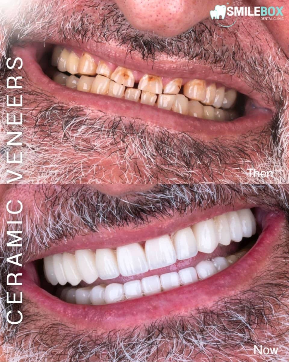 Case 18741 - ceramic veneers