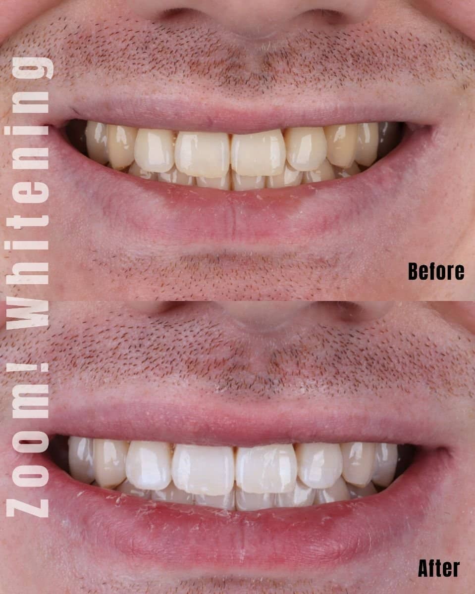 Case 18742 - tooth whitening