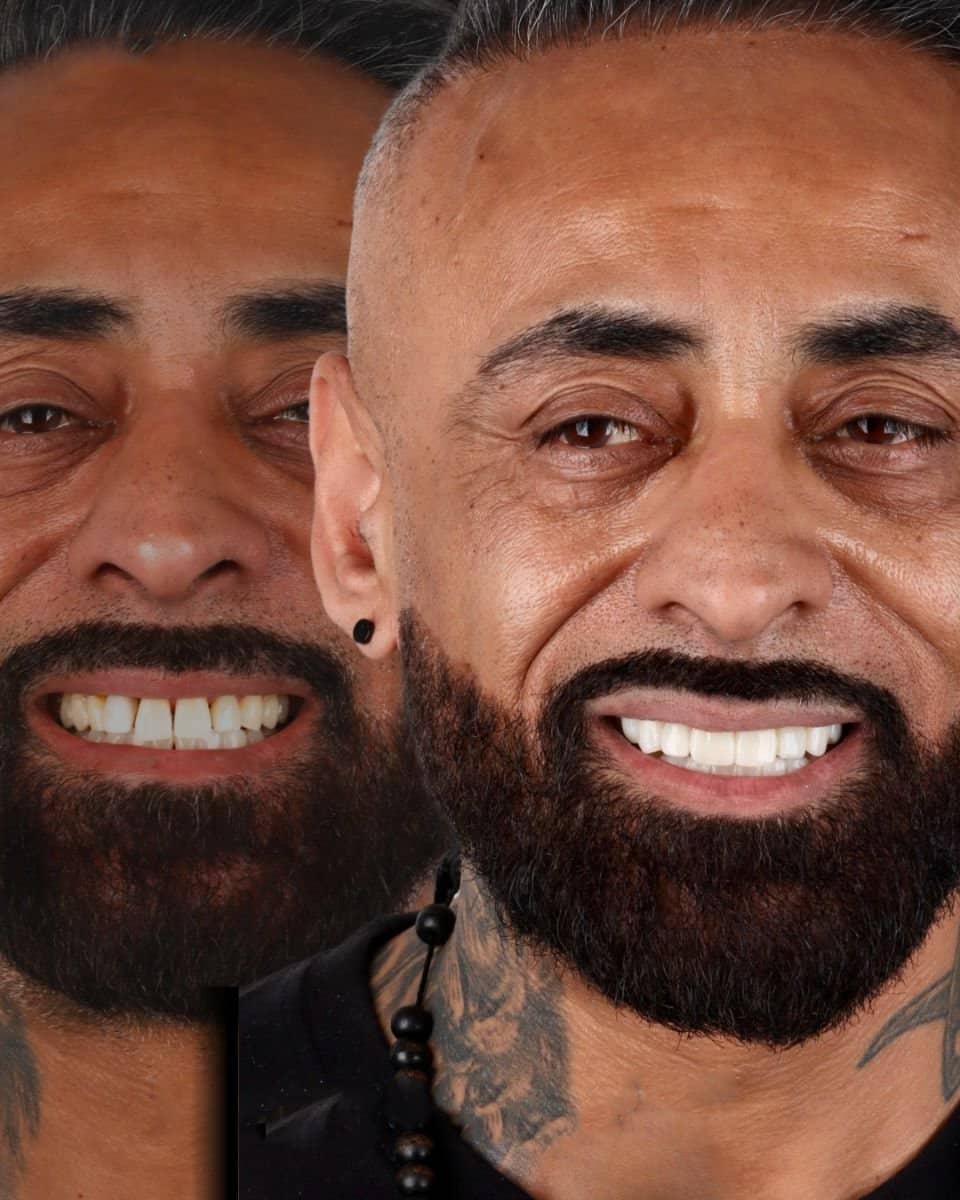 Case 18745 - veneers