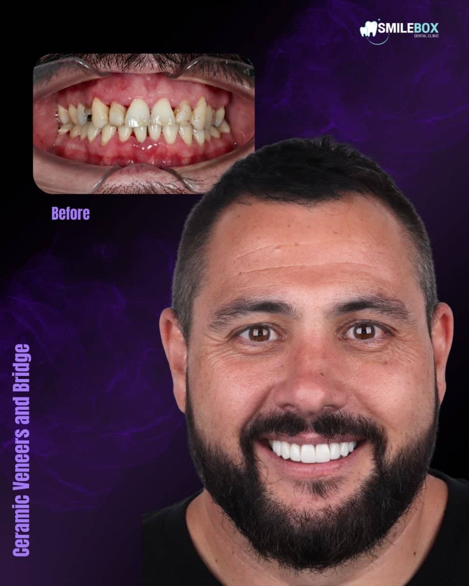 Case 18746 - ceramic veneers and bridge