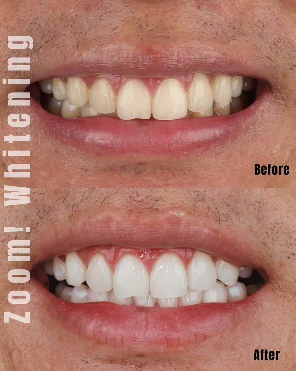 Case 18748 - tooth whitening