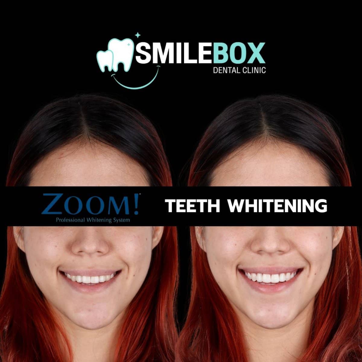 Case 18749 - teeth whitening