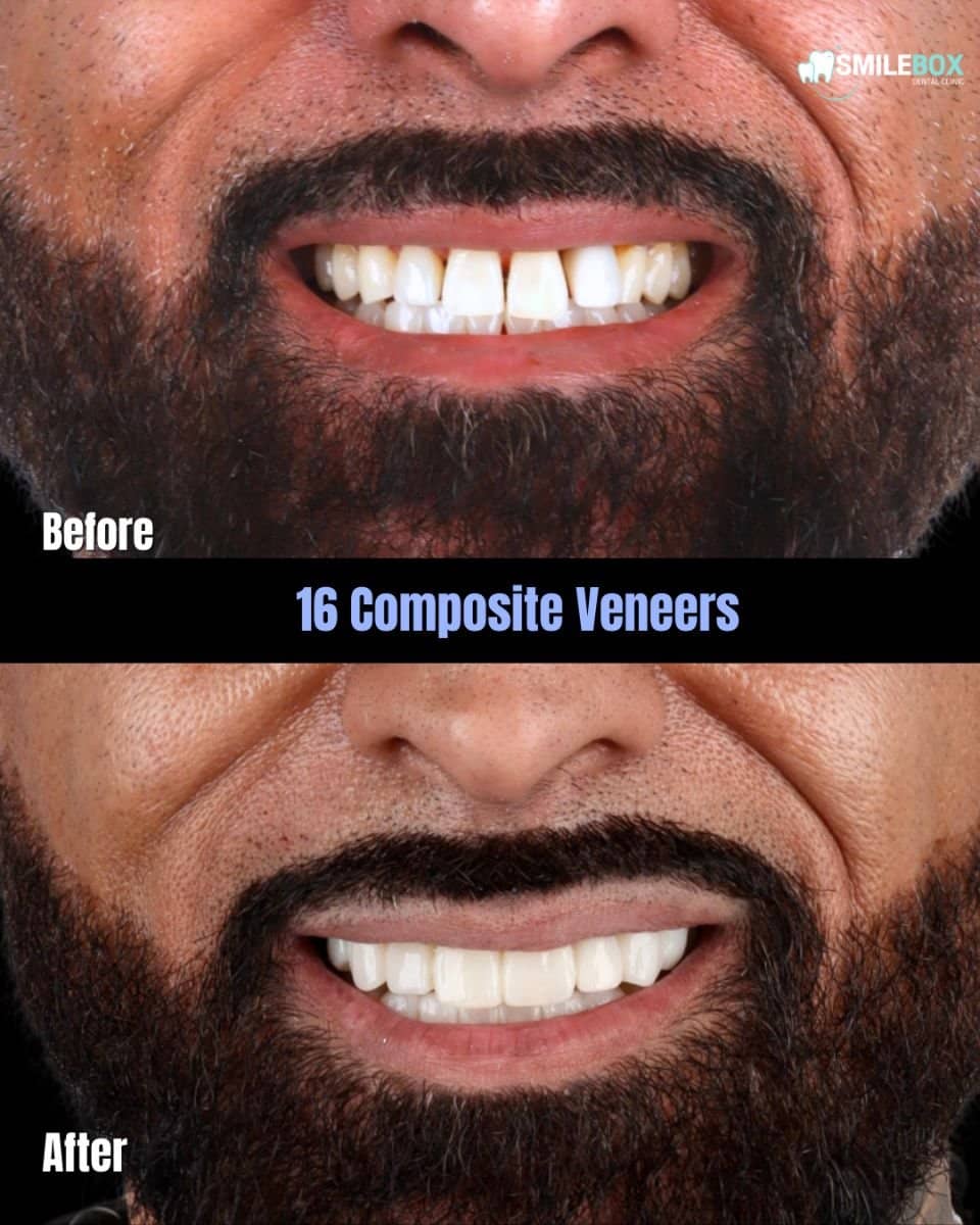 Case 18750 - results of 16 composite veneers