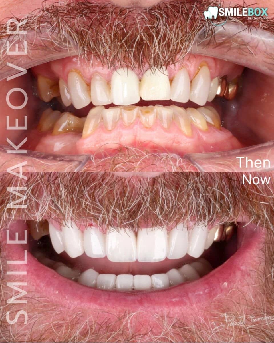 Case 18751 - results with dental veneers