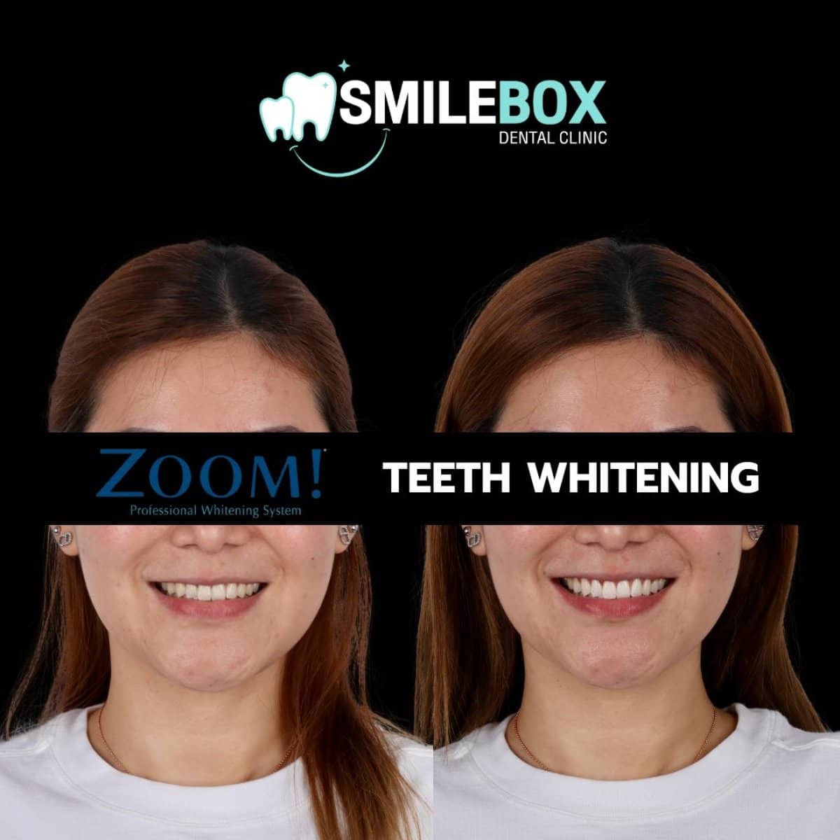 Case 18756 - teeth whitening
