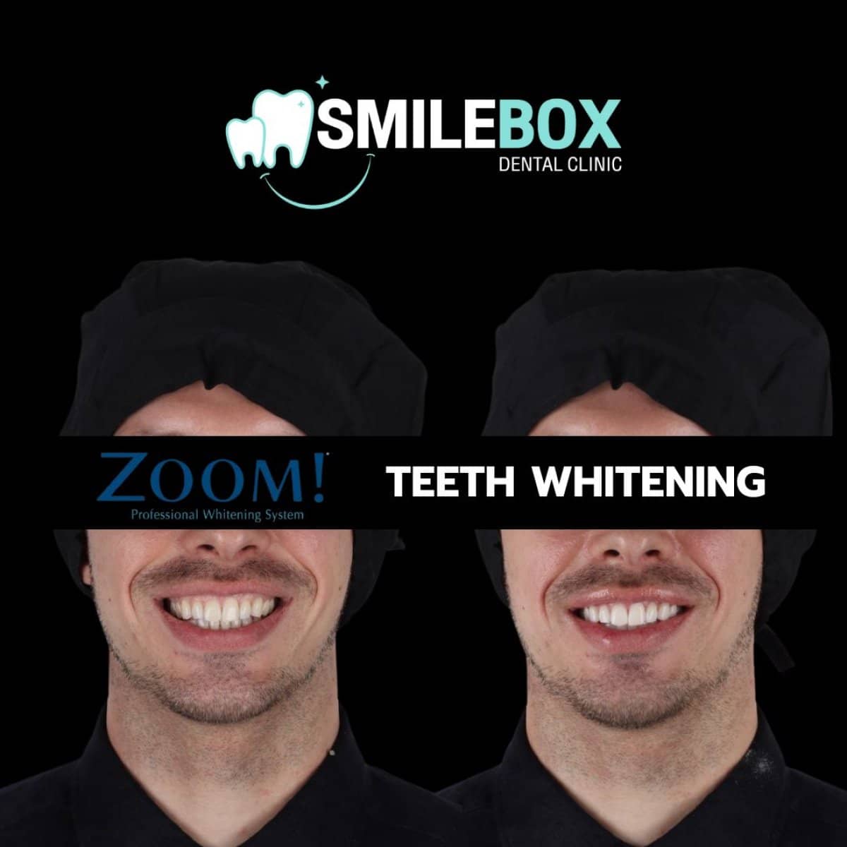 Case 18757 - teeth whitening