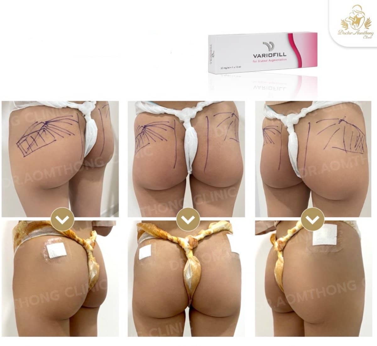 Case 18758 - buttocks fillers injection