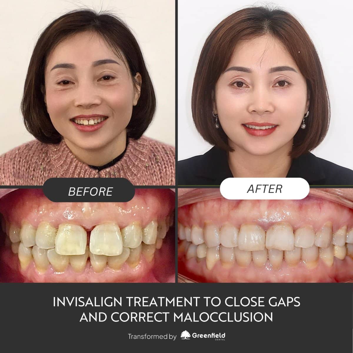 Case 18789 - Invisalign