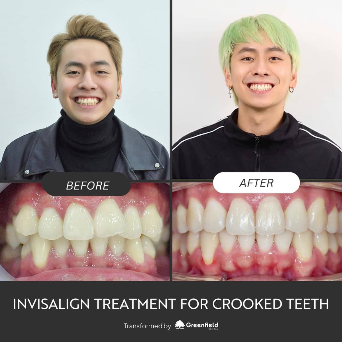 Case 18790 - Invisalign