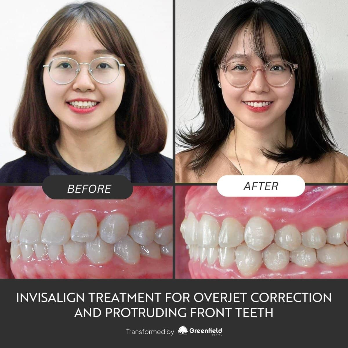 Case 18791 - Invisalign for overjet correction
